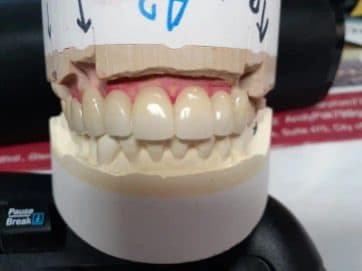 Nexus Dental Lab restoration case