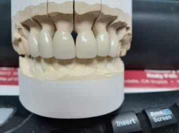 Nexus Dental Lab restoration case on model