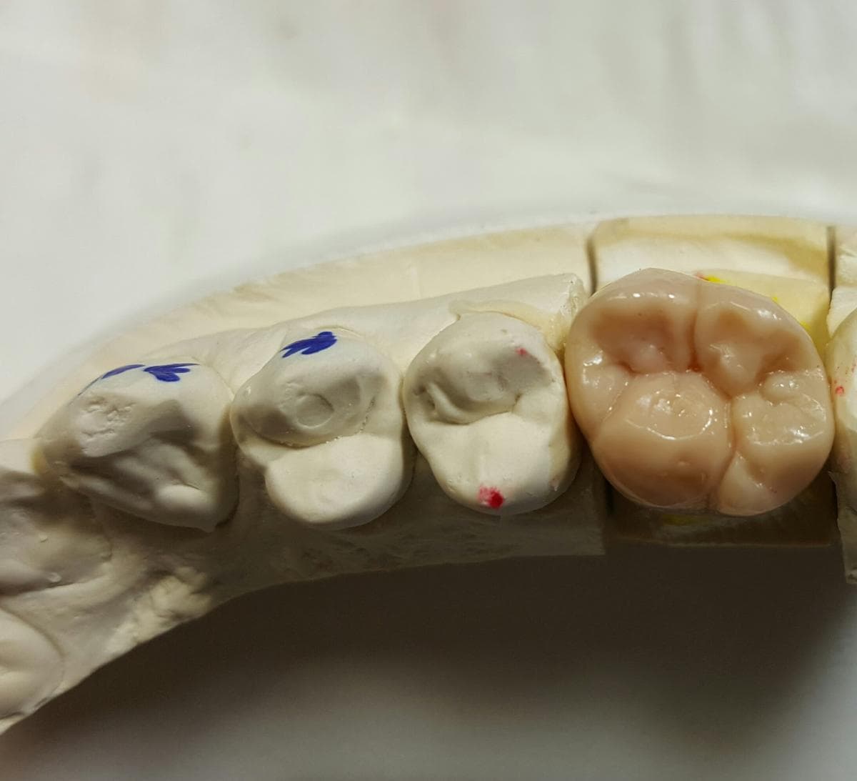 Dental crown and bridge case