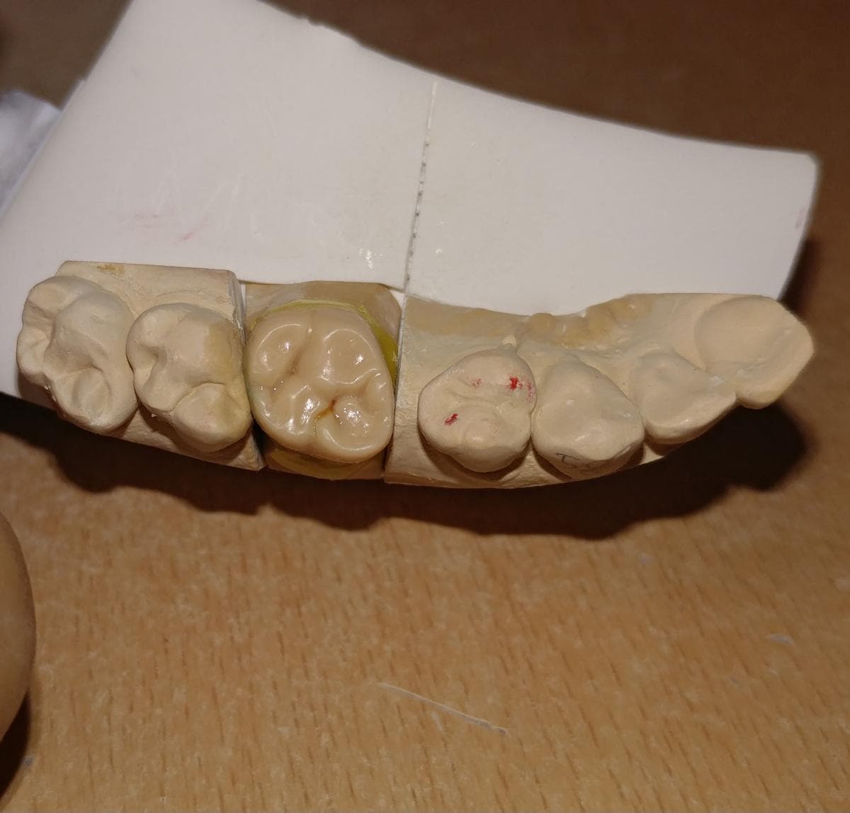 Finished dental restoration