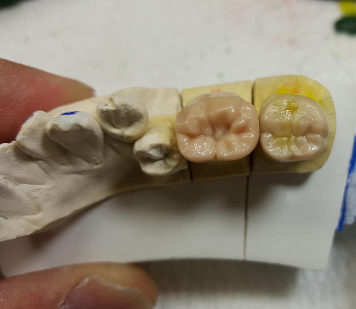 Precision dental restoration