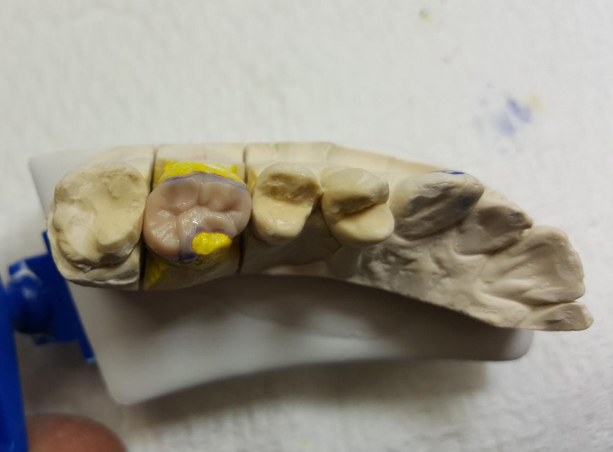 Dental lab crown case