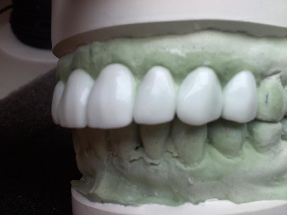 Dental restoration close up