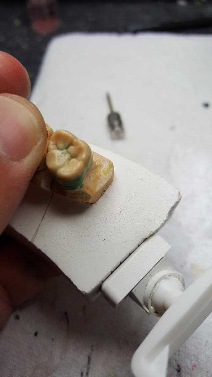 Nexus Dental Lab restorative work