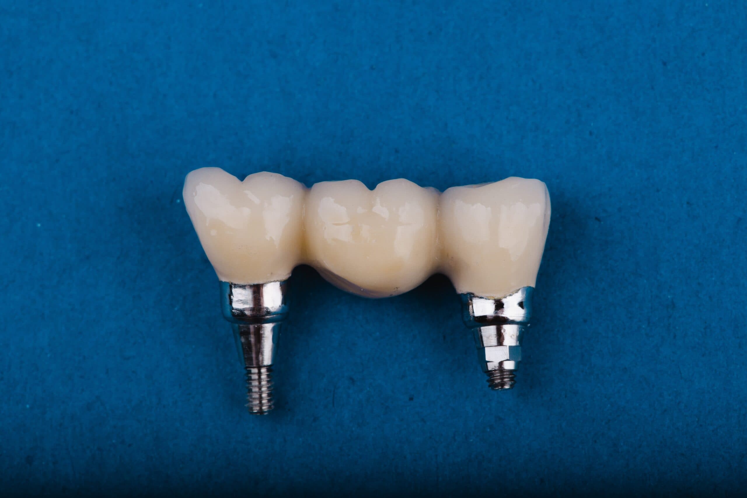 Advanced crown restoration work
